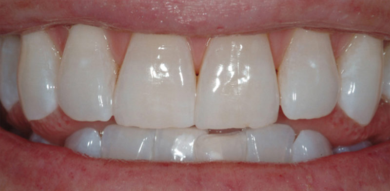 Zahnaufhellung mit Bleaching - Danach Zahnaufhellung mit Bleaching - Danach
