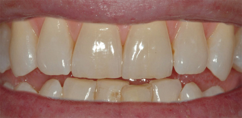 Zahnaufhellung mit Bleaching - Davor Zahnaufhellung mit Bleaching - Davor