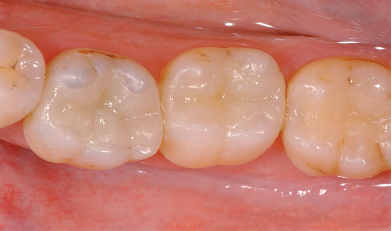 Vergleich Amalgam und Kompostifüllung - Danach Vergleich Amalgam und Kompostifüllung - Danach